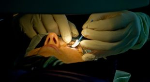 Lasik Surgery: What You Need To Know